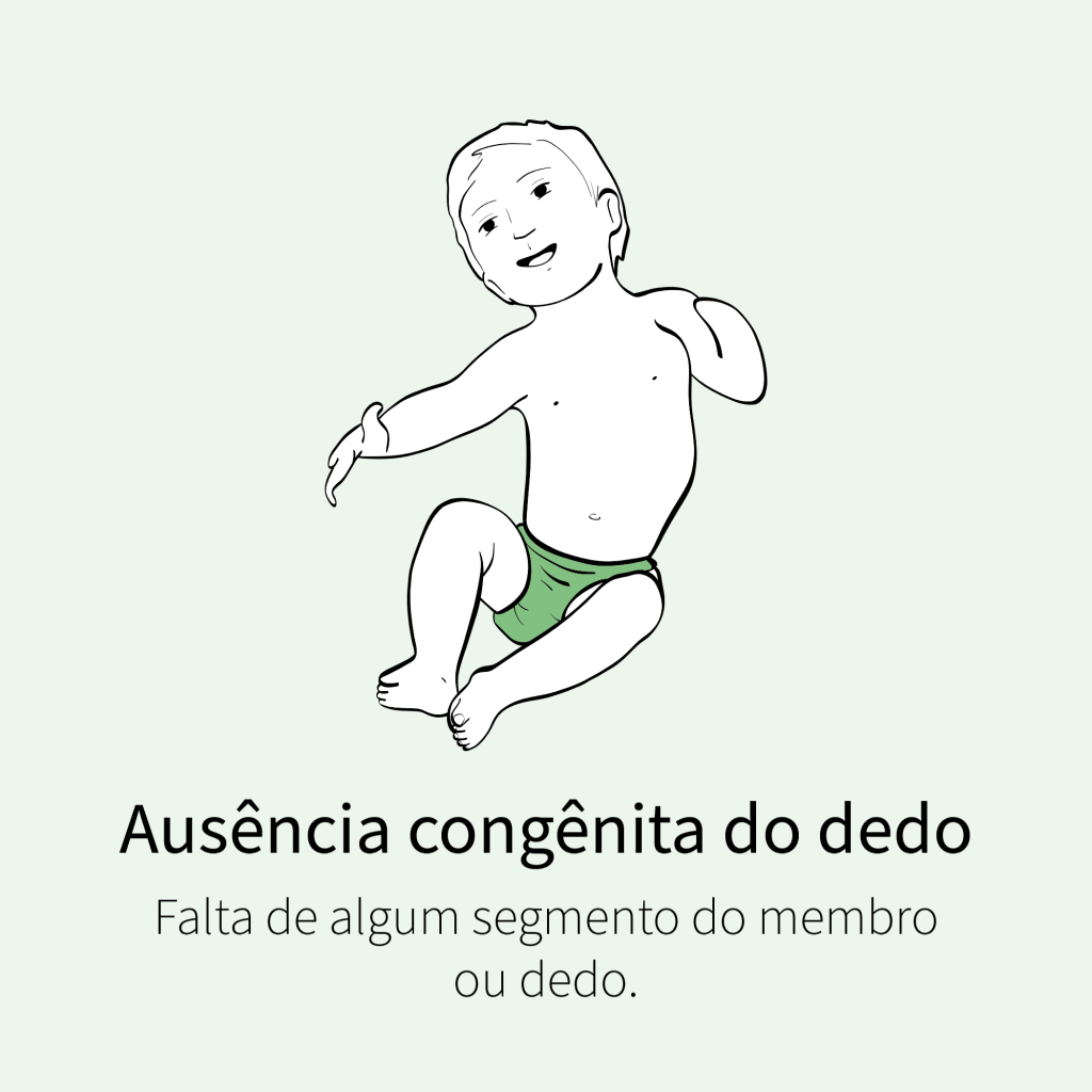 Falta de algum segmento do membro ou dedo.