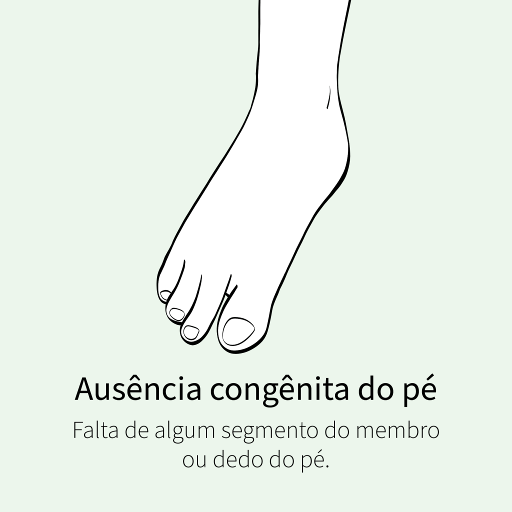 Falta de algum segmento do membro ou dedo no pé.