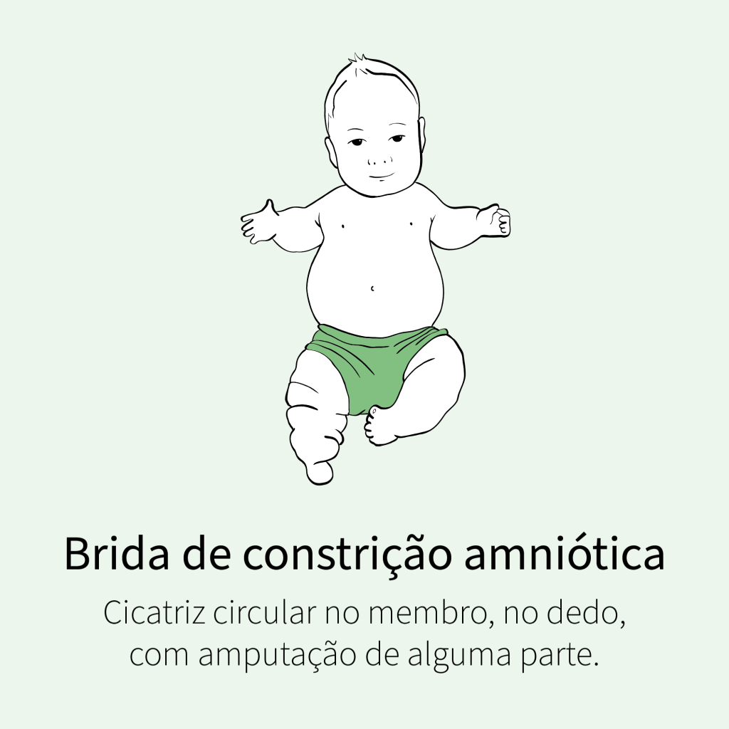 Cicatriz circular no membro, no dedo, com amputação de alguma parte.