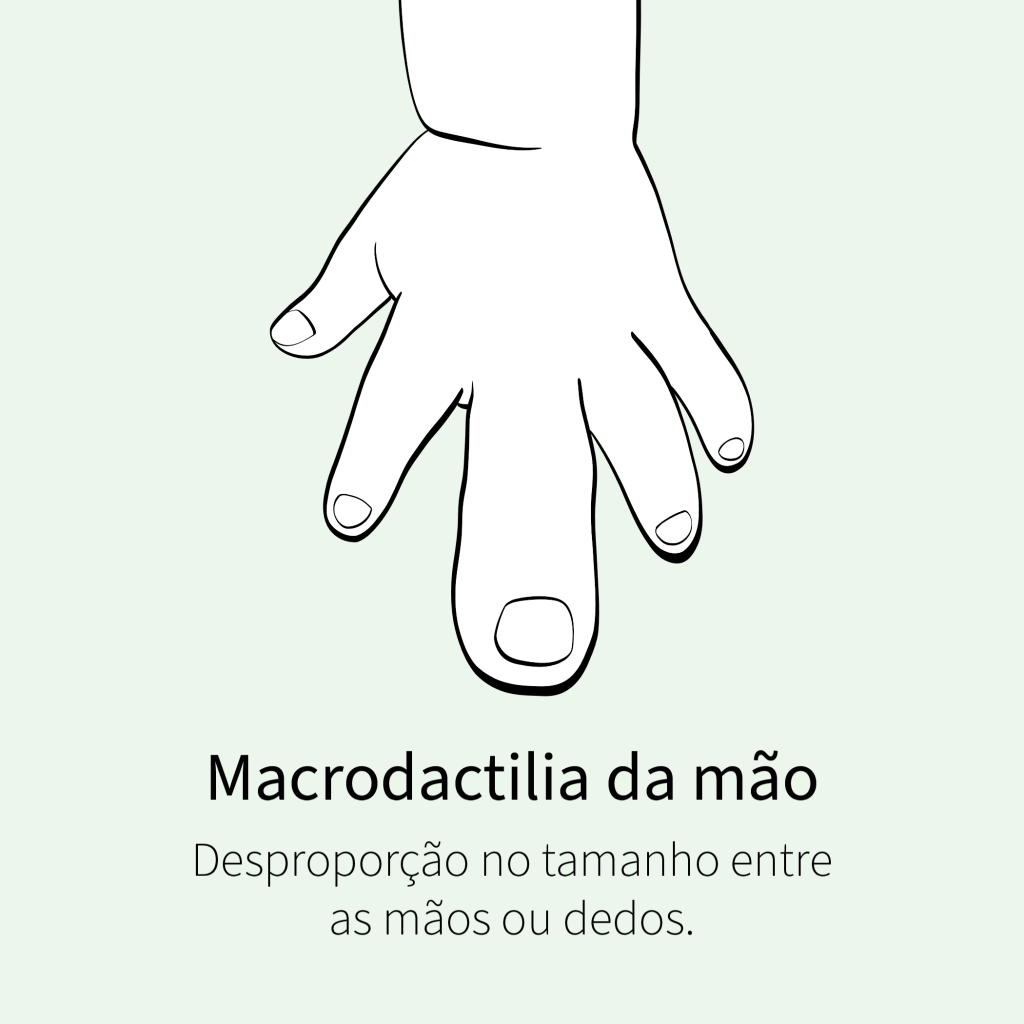 Desproporção no tamanho entre as mãos ou dedos.