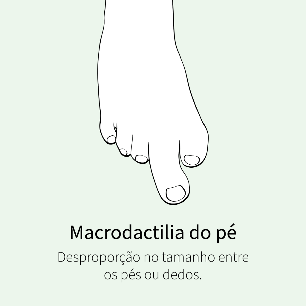 Desproporção no tamanho entre os pés ou dedos.