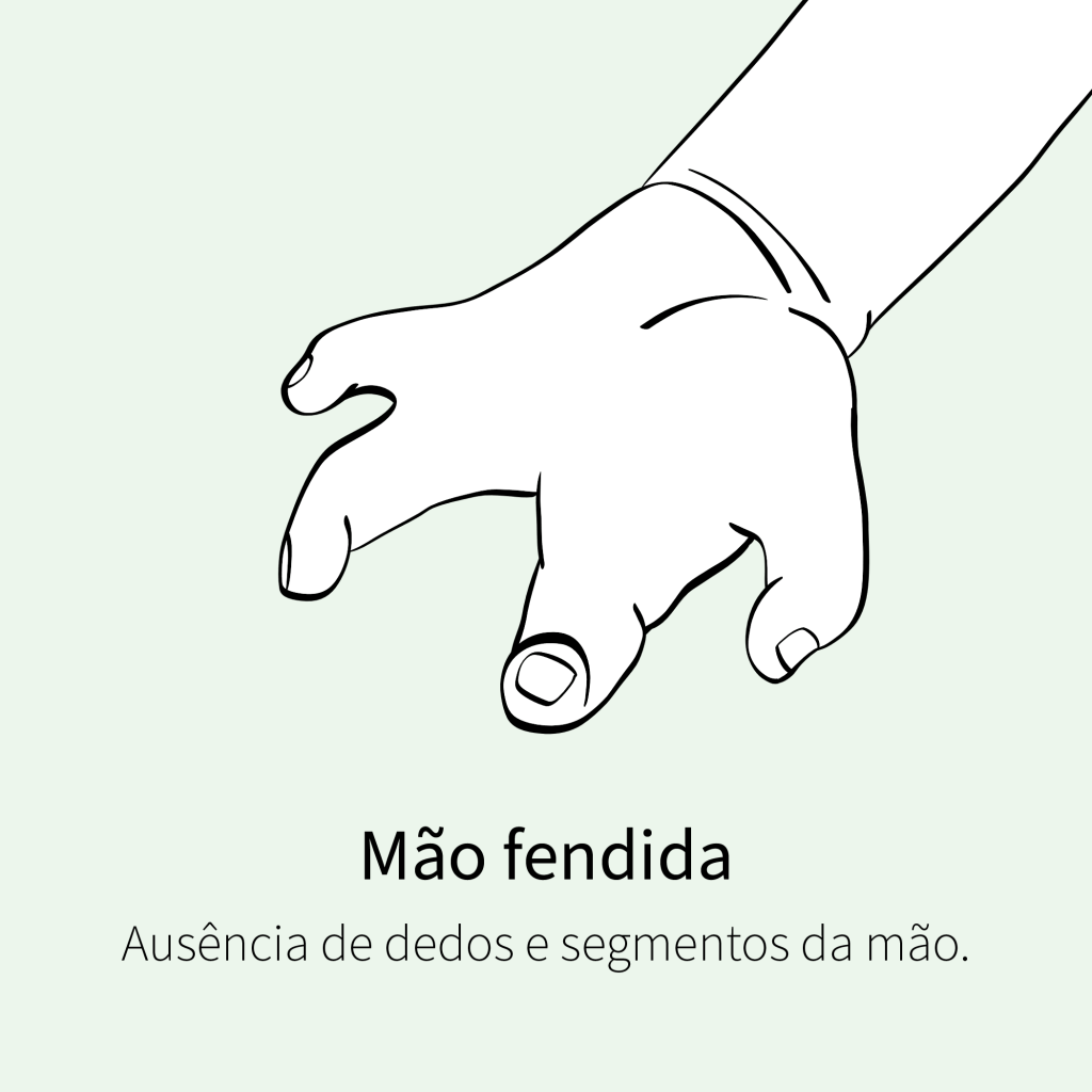 Ausência de dedos e segmentos da mão.
