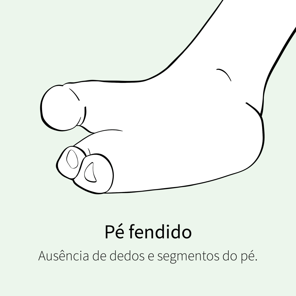 Ausência de dedos e segmentos do pé.