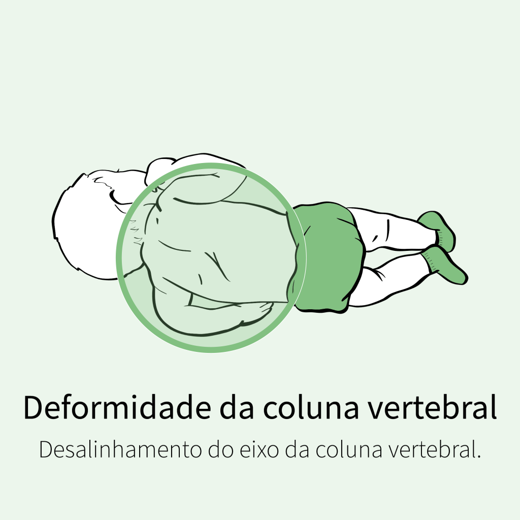 Desalinhamento do eixo da coluna vertebral.