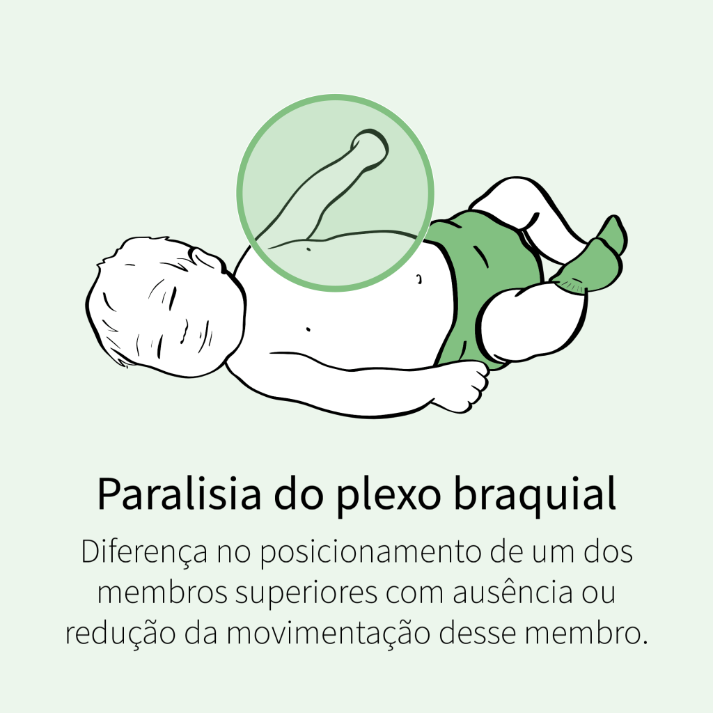 Diferença no posicionamento de um dos membros superiores com ausência ou redução da movimentação desse membro.