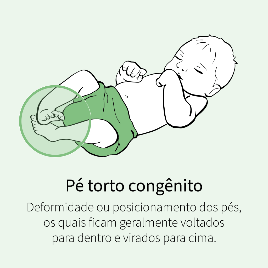 Deformidade ou posicionamento dos pés, os quais ficam geralmente voltados para dentro e virados para cima.