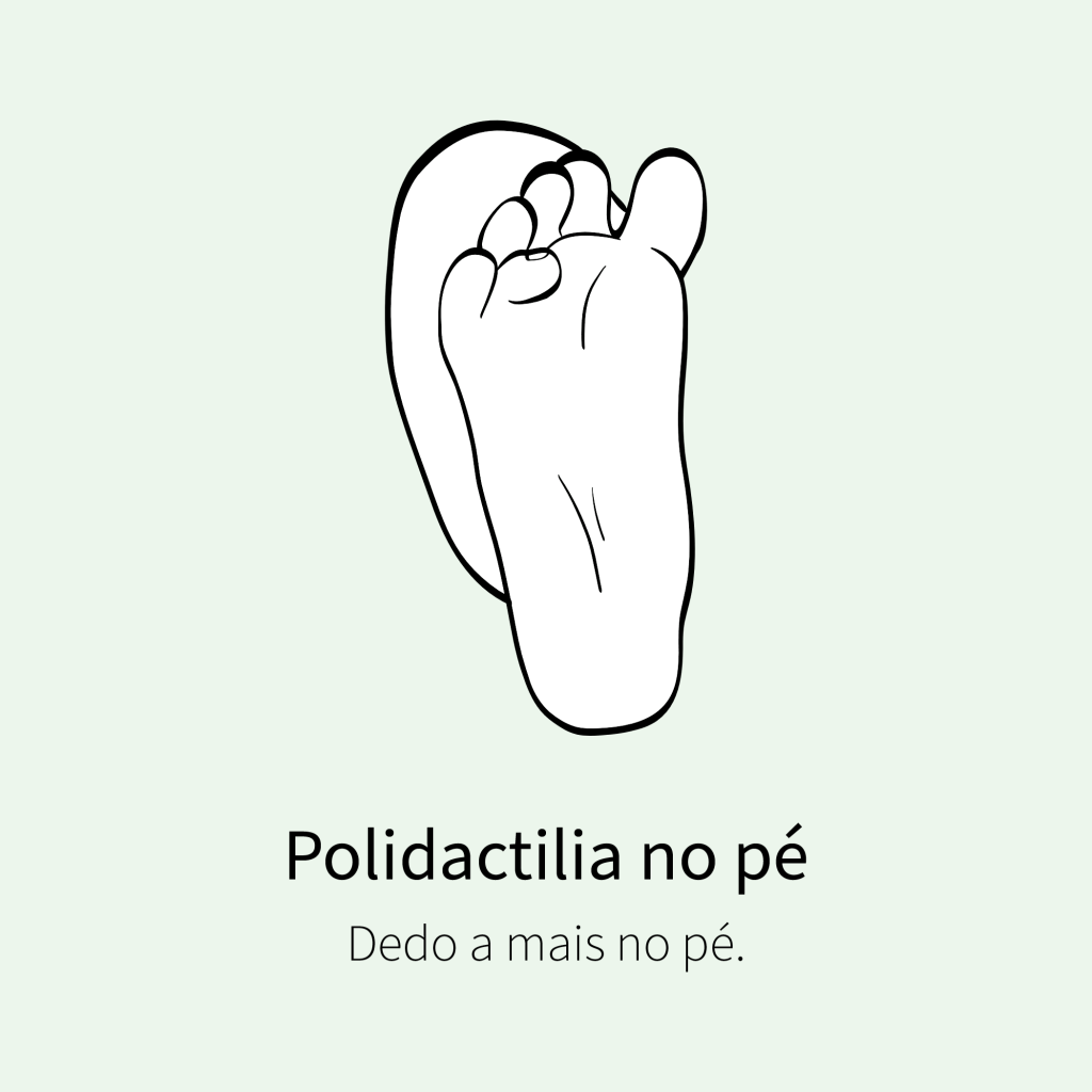 Dedo a mais no pé.